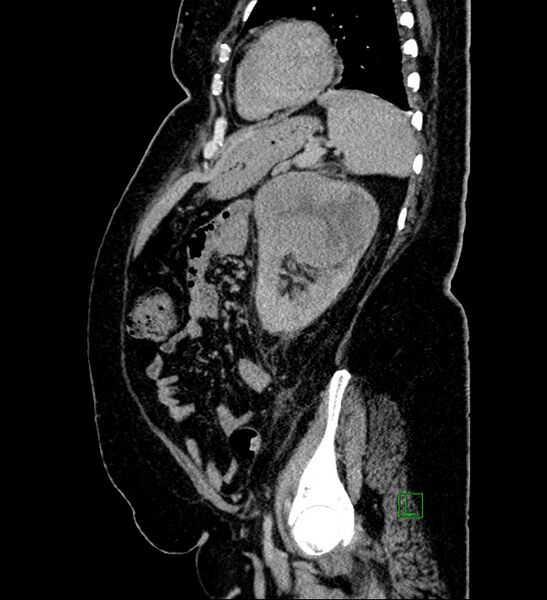 File:Chromophobe renal cell carcinoma (Radiopaedia 84239-99519 G 35).jpg