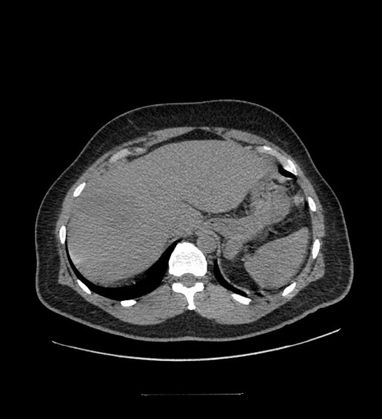 File:Chromophobe renal cell carcinoma (Radiopaedia 84337-99644 Axial non-contrast 16).jpg