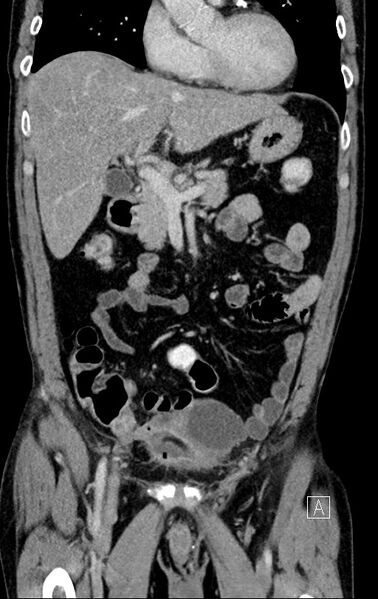 File:Chronic appendicitis complicated by appendicular abscess, pylephlebitis and liver abscess (Radiopaedia 54483-60700 C 30).jpg