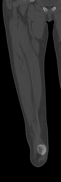 File:Chronic ostemyelitis of the femur with long sinus tract (Radiopaedia 74947-85982 Coronal bone window 26).jpg