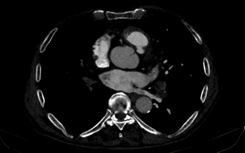 File:Chronic pulmonary embolism (Radiopaedia 91241-108843 B 109).jpg