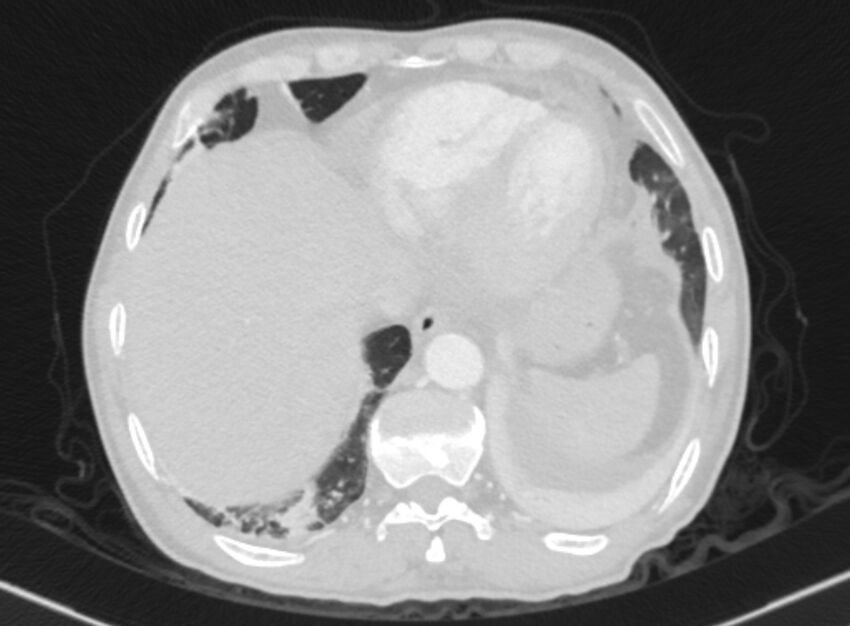 Chronic pulmonary embolism with bubbly consolidation (Radiopaedia 91248-108850 Axial lung window 129).jpg