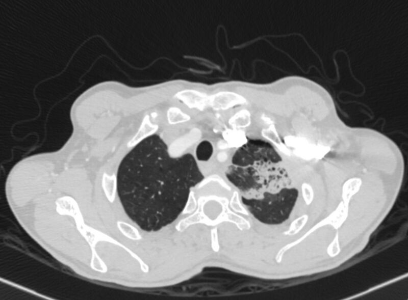 File:Chronic pulmonary embolism with bubbly consolidation (Radiopaedia 91248-108850 Axial lung window 17).jpg