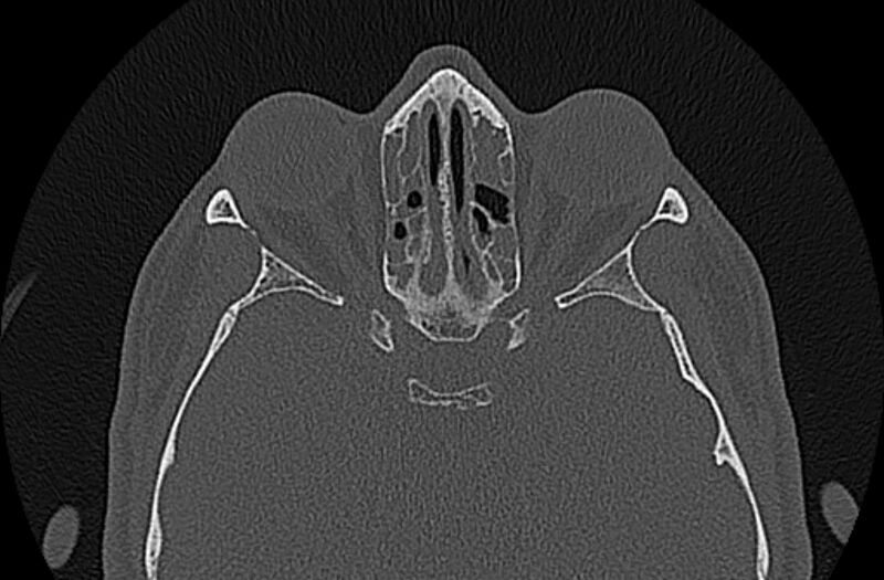 File:Chronic rhinosinusitis (Radiopaedia 65079-74075 Axial bone window 57).jpg