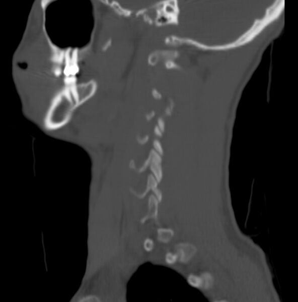 File:Cleft of the posterior arch of C1 mimicking fracture (Radiopaedia 40201-42721 Sagittal bone window 17).jpg