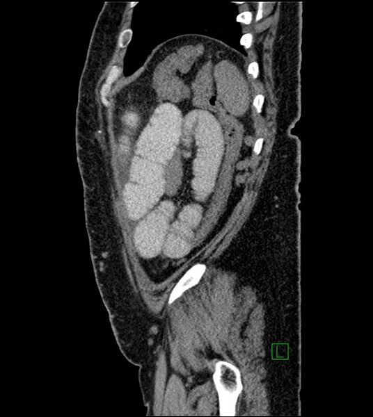 File:Closed-loop small bowel obstruction-internal hernia (Radiopaedia 78439-91096 C 30).jpg