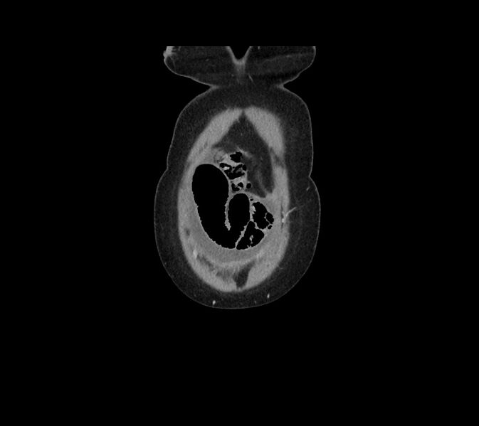 File:Cocoon abdomen with possible tubo-ovarian abscess (Radiopaedia 46235-50636 B 3).jpg