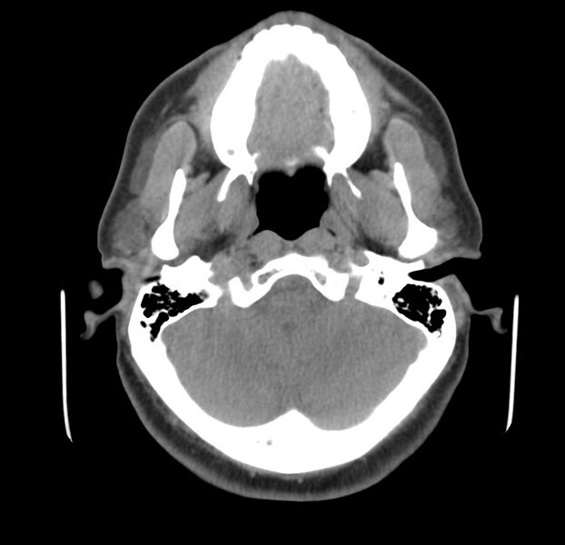 File:Colloid cyst of thyroid (Radiopaedia 22897-22923 Axial non-contrast 8).jpg
