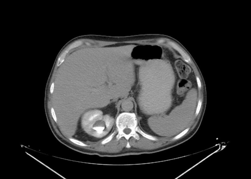 File:Colon cancer mimicking renal cell carcinoma (Radiopaedia 28986-29335 Axial C+ delayed 16).jpg