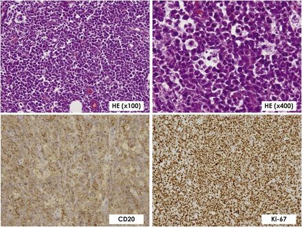 Histopathological findings confirming Burkitt lymphoma with lymphocytes staining positive for CD20 and Ki-67