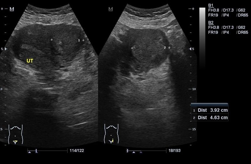 File:Leiomyoma of uterus (Radiopaedia 17481).jpg