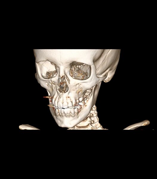 File:Nasoorbitoethmoid fracture (Radiopaedia 90044-107205 3D VRT 21).jpg