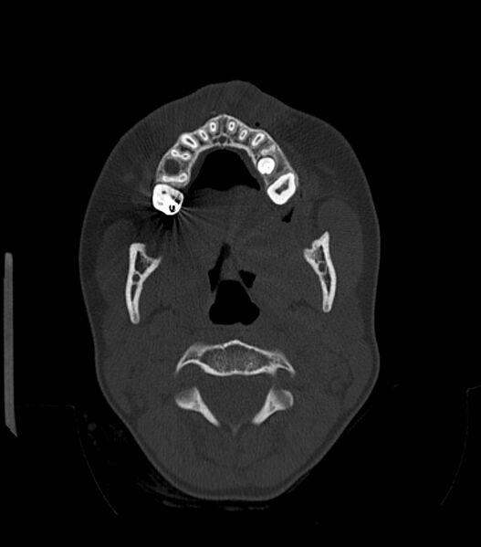 File:Nasoorbitoethmoid fracture (Radiopaedia 90044-107205 Axial bone window 45).jpg