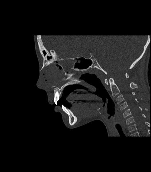 File:Nasoorbitoethmoid fracture (Radiopaedia 90044-107205 Sagittal bone window 75).jpg