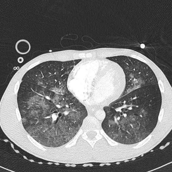 File:Near drowning (pulmonary edema) (Radiopaedia 24685-24958 lung window 46).jpg