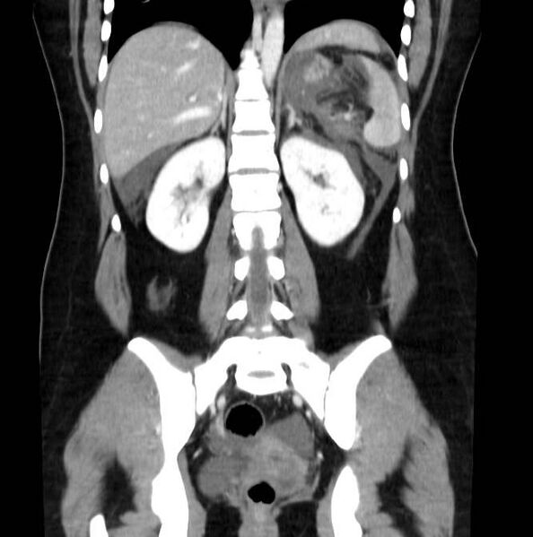 File:Necrotizing pancreatitis (Radiopaedia 23001-23031 B 45).jpg