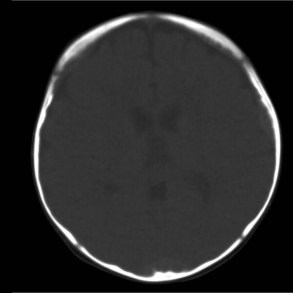 File:Neuroblastoma with skull metastases (Radiopaedia 30326-30958 Axial bone window 12).jpg