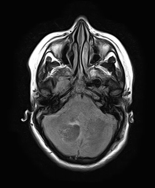 File:Neurofibromatosis type 2 (Radiopaedia 66211-75401 Axial FLAIR 10).jpg