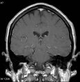 Neurosarcoidosis (Radiopaedia 10930-17204 Coronal T1 C+ 11).jpg