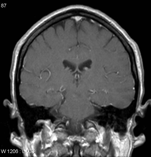 File:Neurosarcoidosis (Radiopaedia 10930-17204 Coronal T1 C+ 11).jpg