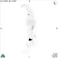 Non-Hodgkin lymphoma involving seminal vesicles with development of interstitial pneumonitis during Rituximab therapy (Radiopaedia 32703-33752 PET cor 3D MIP 4).jpg