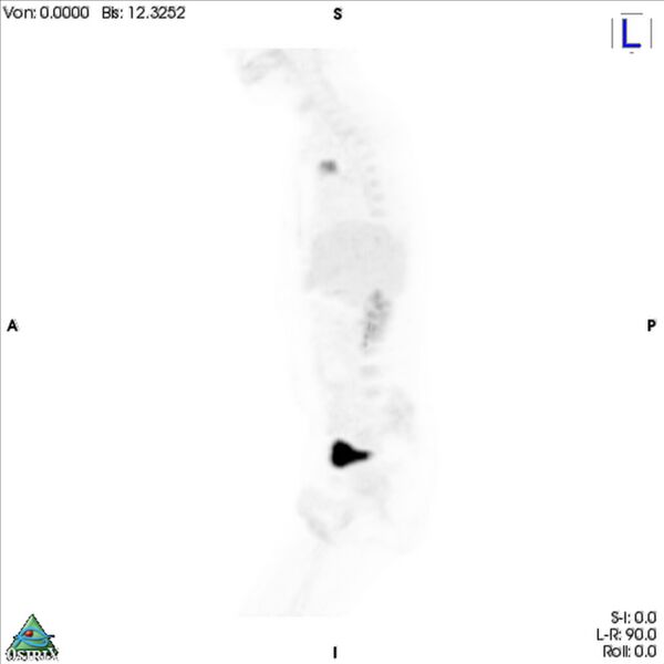 File:Non-Hodgkin lymphoma involving seminal vesicles with development of interstitial pneumonitis during Rituximab therapy (Radiopaedia 32703-33752 PET cor 3D MIP 4).jpg