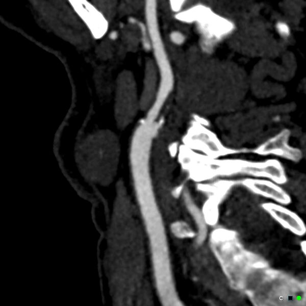 File:Non-occlusive intraluminal internal carotid artery thrombus (Radiopaedia 37751-39658 C 47).jpg