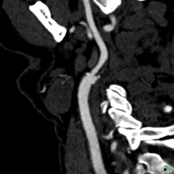 File:Non-occlusive intraluminal internal carotid artery thrombus (Radiopaedia 37751-39658 C 50).jpg