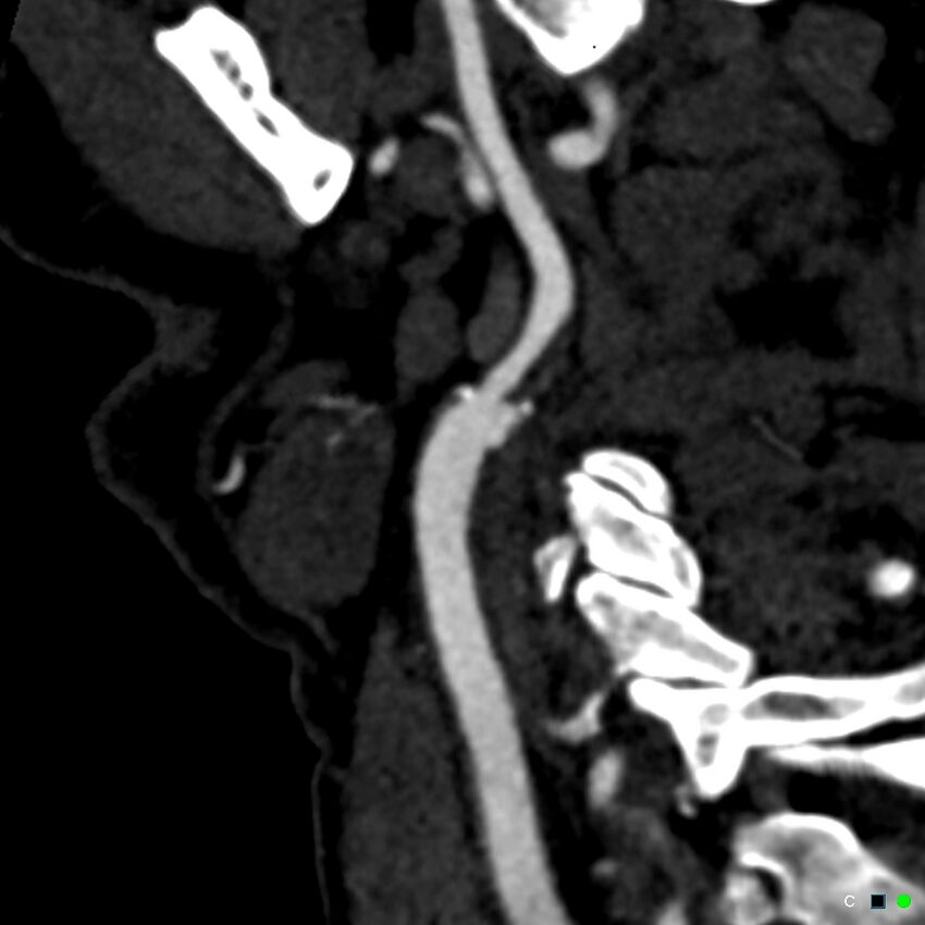 Non-occlusive intraluminal internal carotid artery thrombus (Radiopaedia 37751-39658 C 50).jpg