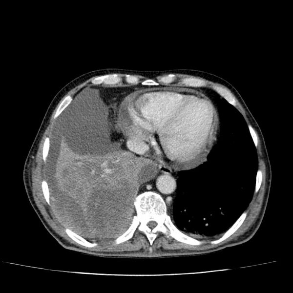 File:Non small-cell lung cancer (Radiopaedia 24467-24769 C+ delayed 47).jpg