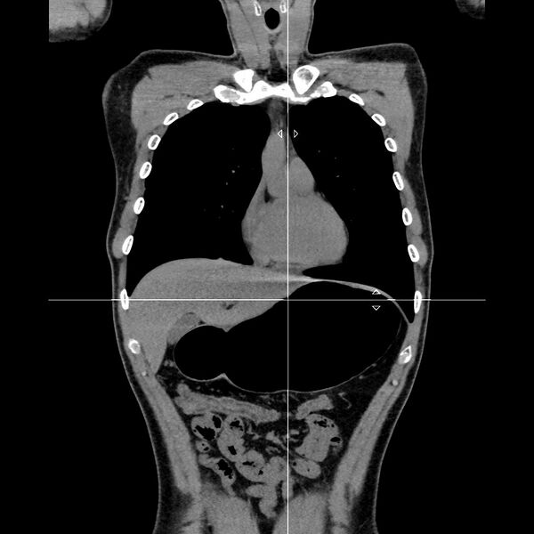 File:Normal CT virtual gastroscopy (Radiopaedia 29960-30501 D 2).jpg