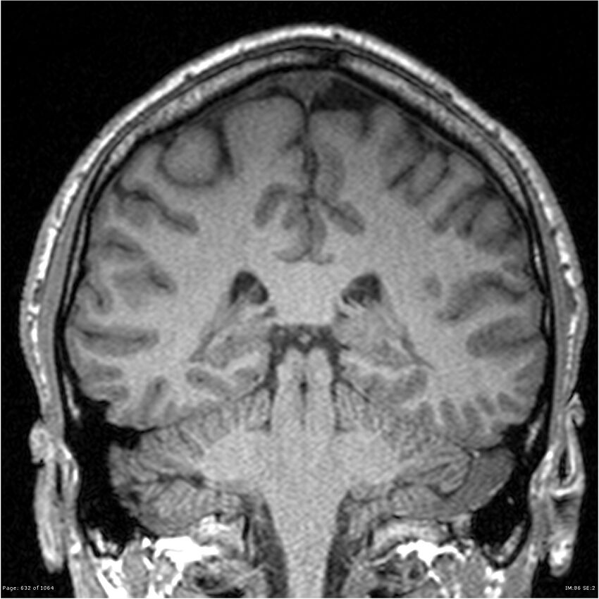 Normal brain MRI (non-focal epilepsy protocol) (Radiopaedia 38571-40700 Coronal T1 42).jpg