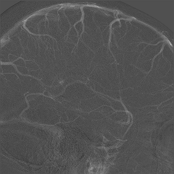 File:Normal cerebral angiogram (four vessel DSA) (Radiopaedia 41708-44649 F 18).png