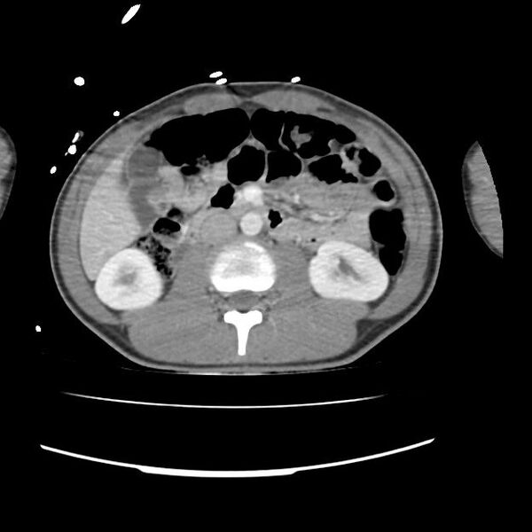 File:Normal dual-phase trauma CT chest,abdomen and pelvis (Radiopaedia 48092-52899 A 69).jpg
