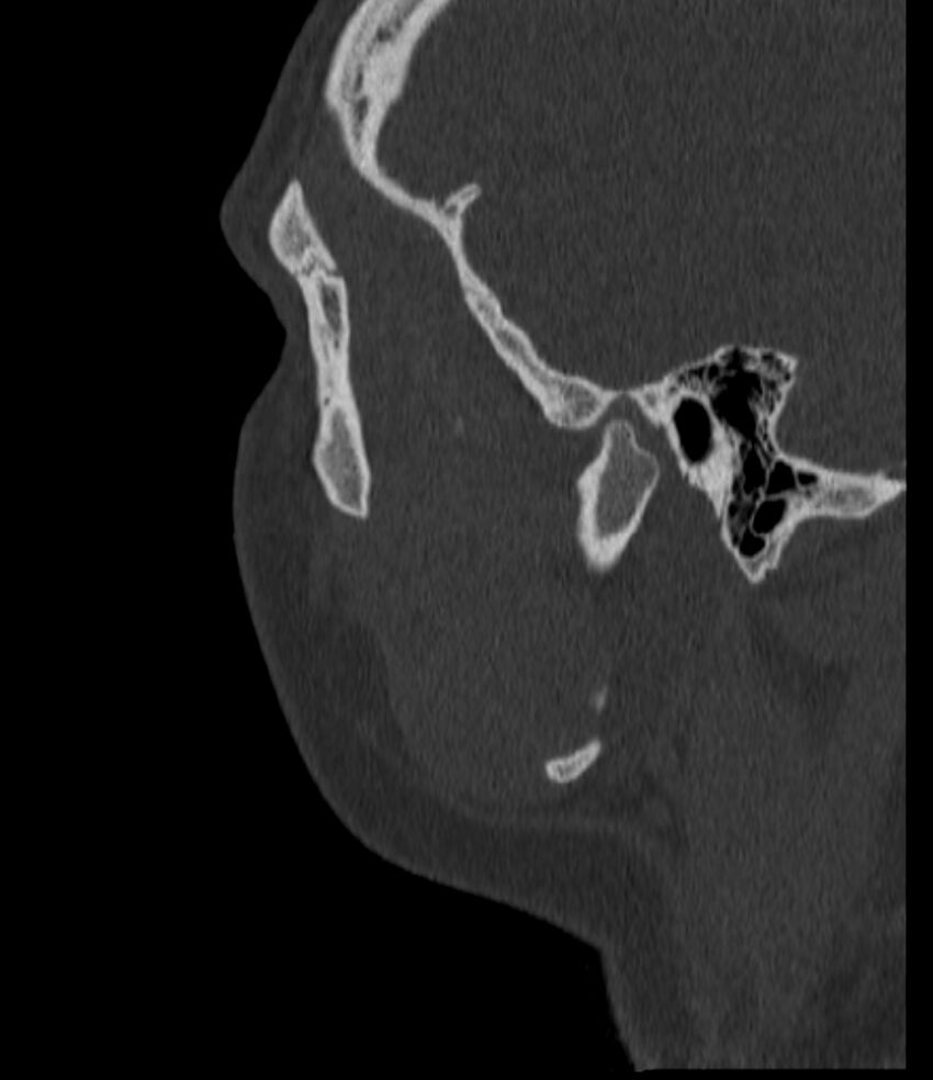 Normal facial bone CT (Radiopaedia 88742-105476 Sagittal bone window 35).jpg
