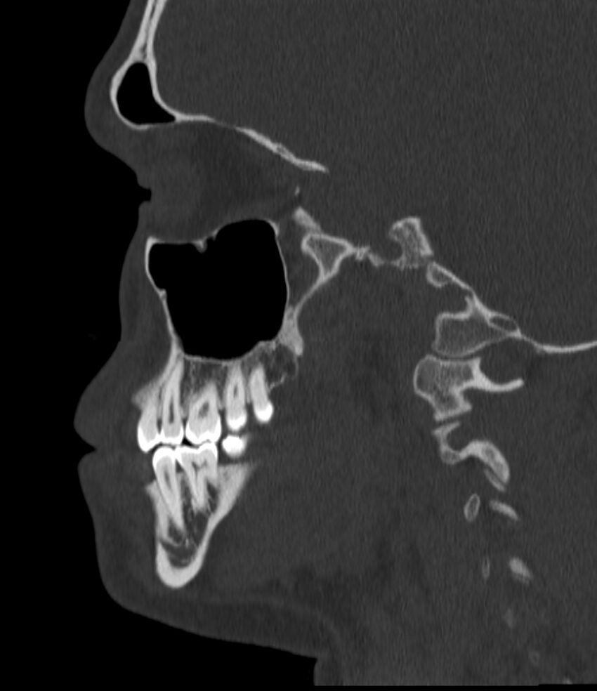 Normal facial bone CT (Radiopaedia 88742-105476 Sagittal bone window 66).jpg