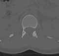 Normal lumbar spine CT (Radiopaedia 46533-50986 Axial bone window 8).png