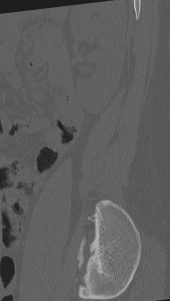 File:Normal lumbar spine CT (Radiopaedia 46533-50986 Sagittal bone window 9).png