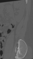 Normal lumbar spine CT (Radiopaedia 46533-50986 Sagittal bone window 9).png