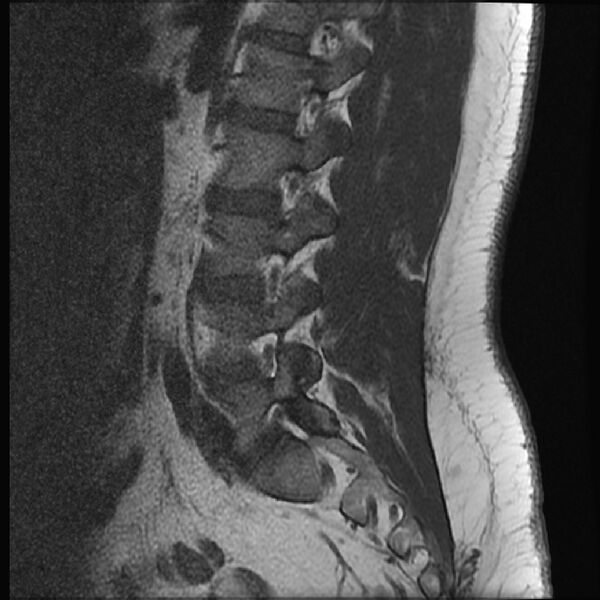 File:Normal lumbar spine MRI (Radiopaedia 43051-46311 Sagittal T1 6).jpg