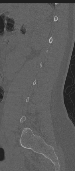 File:Normal lumbosacral CT (Radiopaedia 37923-39867 Sagittal bone window 28).png