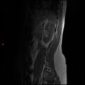 Normal spine MRI (Radiopaedia 77323-89408 Sagittal T1 15).jpg