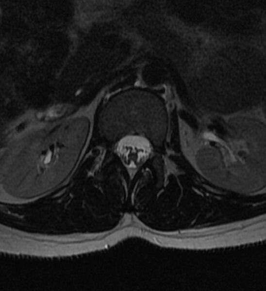 File:Normal thoracic spine MRI (Radiopaedia 41033-43781 Axial T2 34).jpg