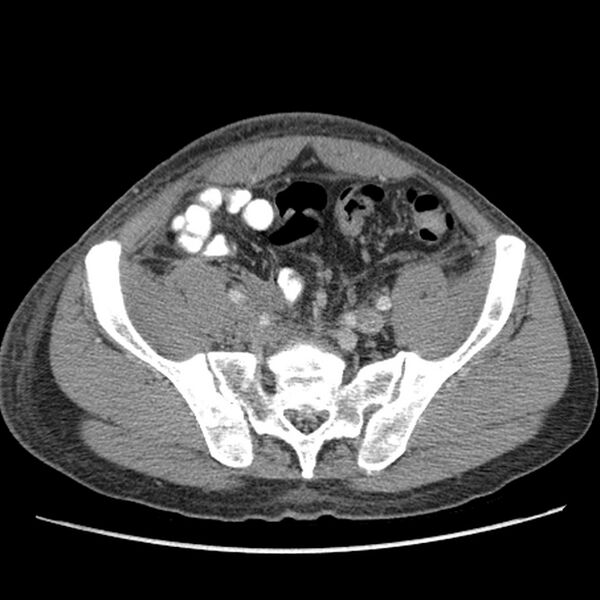 File:Obstructive bladder transitional cell carcinoma (Radiopaedia 9825-10410 A 23).jpg