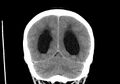 Obstructive hydrocephalus (Radiopaedia 30453-31119 Coronal non-contrast 30).jpg