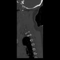 Occipital condyle fracture (Radiopaedia 31755-32691 Sagittal bone window 4).jpg
