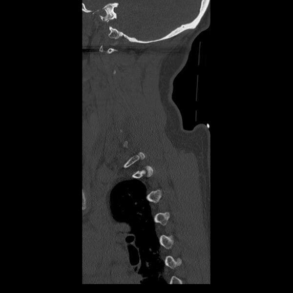 File:Occipital condyle fracture (Radiopaedia 31755-32691 Sagittal bone window 4).jpg