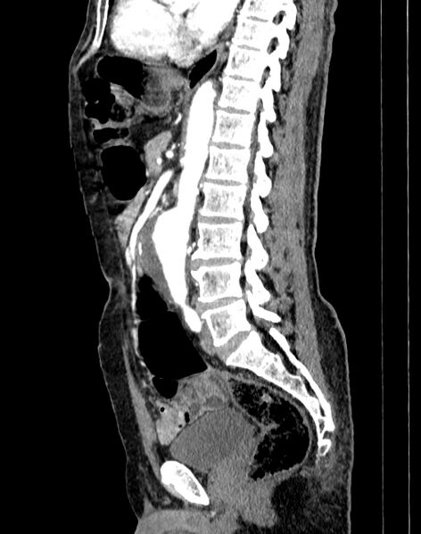 File:Abdominal aortic aneurysm (Radiopaedia 83581-98689 Sagittal C+ arterial phase 50).jpg