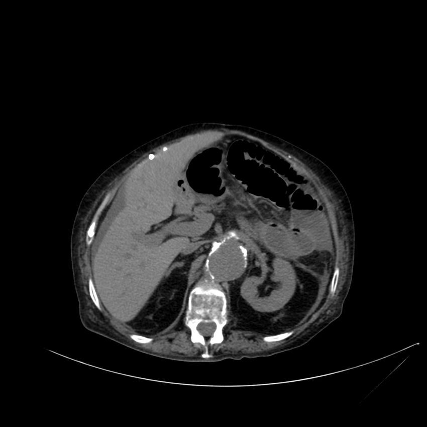 Abdominal aortic aneurysm - impending rupture (Radiopaedia 19233-19246 Axial non-contrast 42).jpg