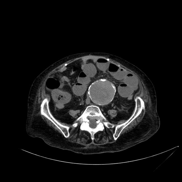 File:Abdominal aortic aneurysm - impending rupture (Radiopaedia 19233-19246 Axial non-contrast 83).jpg